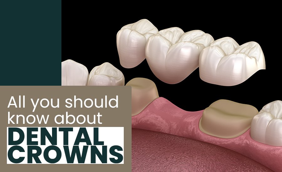 All you should know about dental crowns