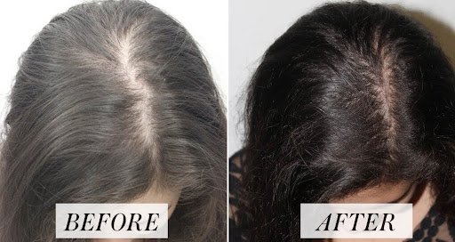 Understanding Hair Loss the Basics